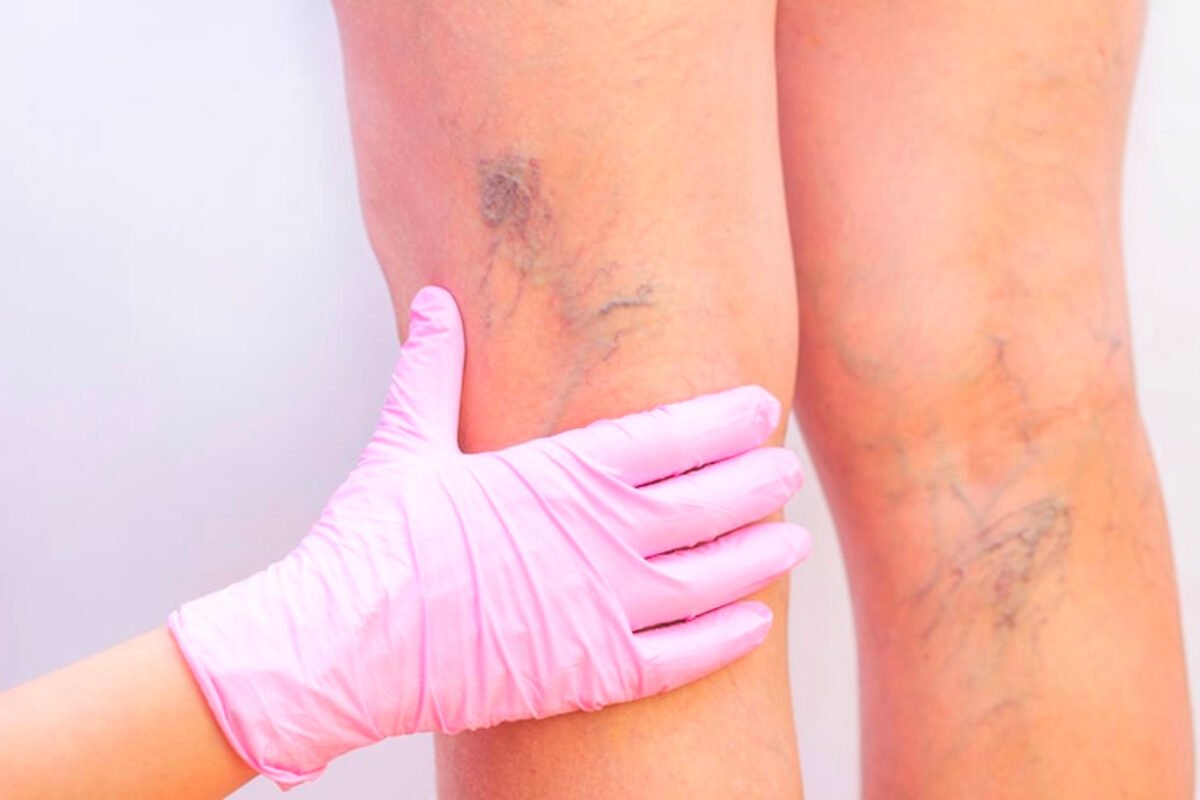 Varices vs. arañas vasculares: diferencias, síntomas y tratamiento